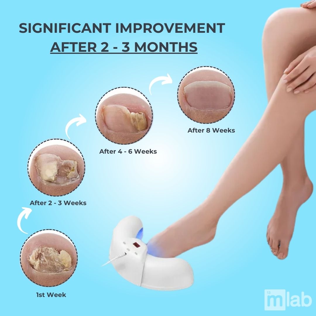 OnyCure™️ - Nail Fungus Laser