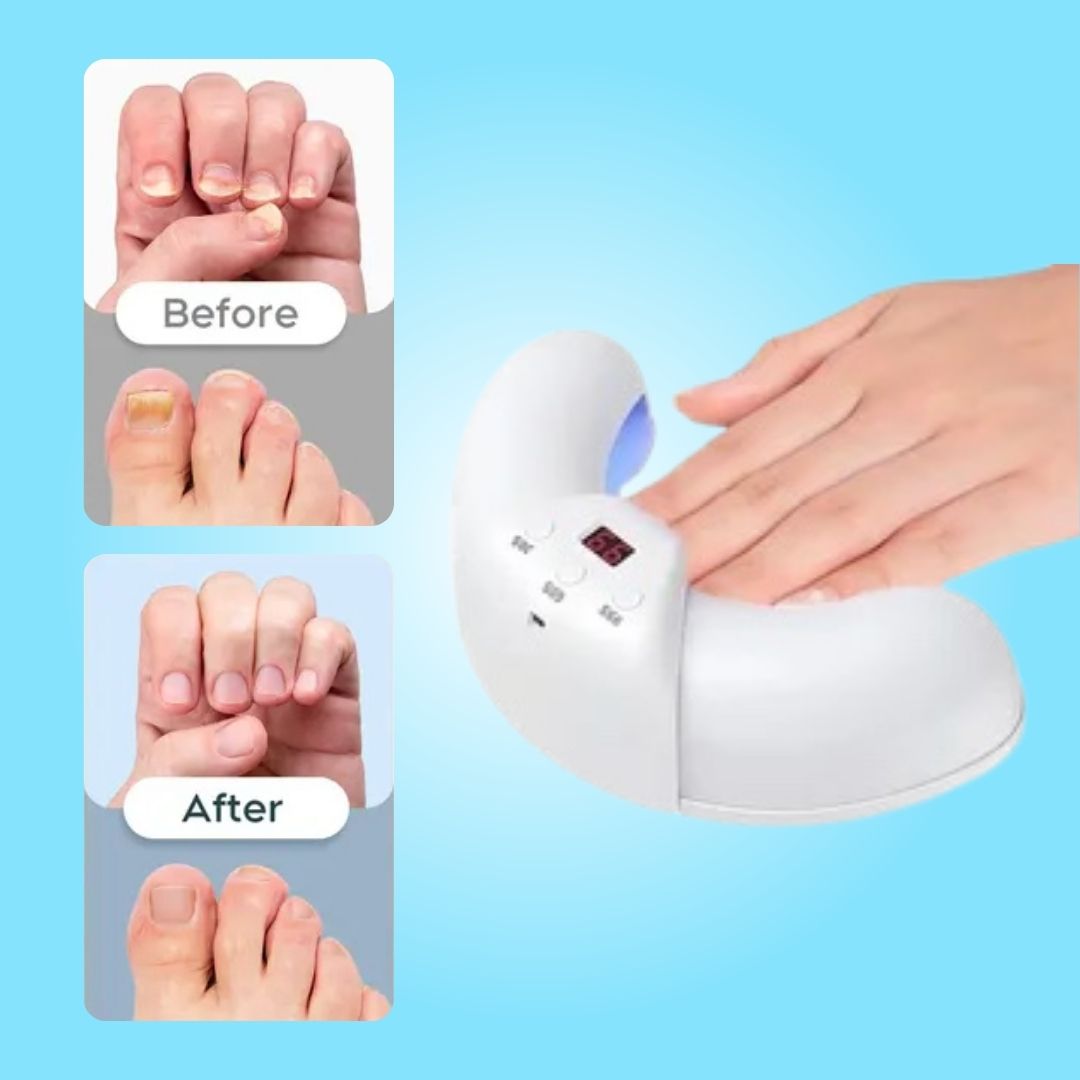 OnyCure™️ - Nail Fungus Laser