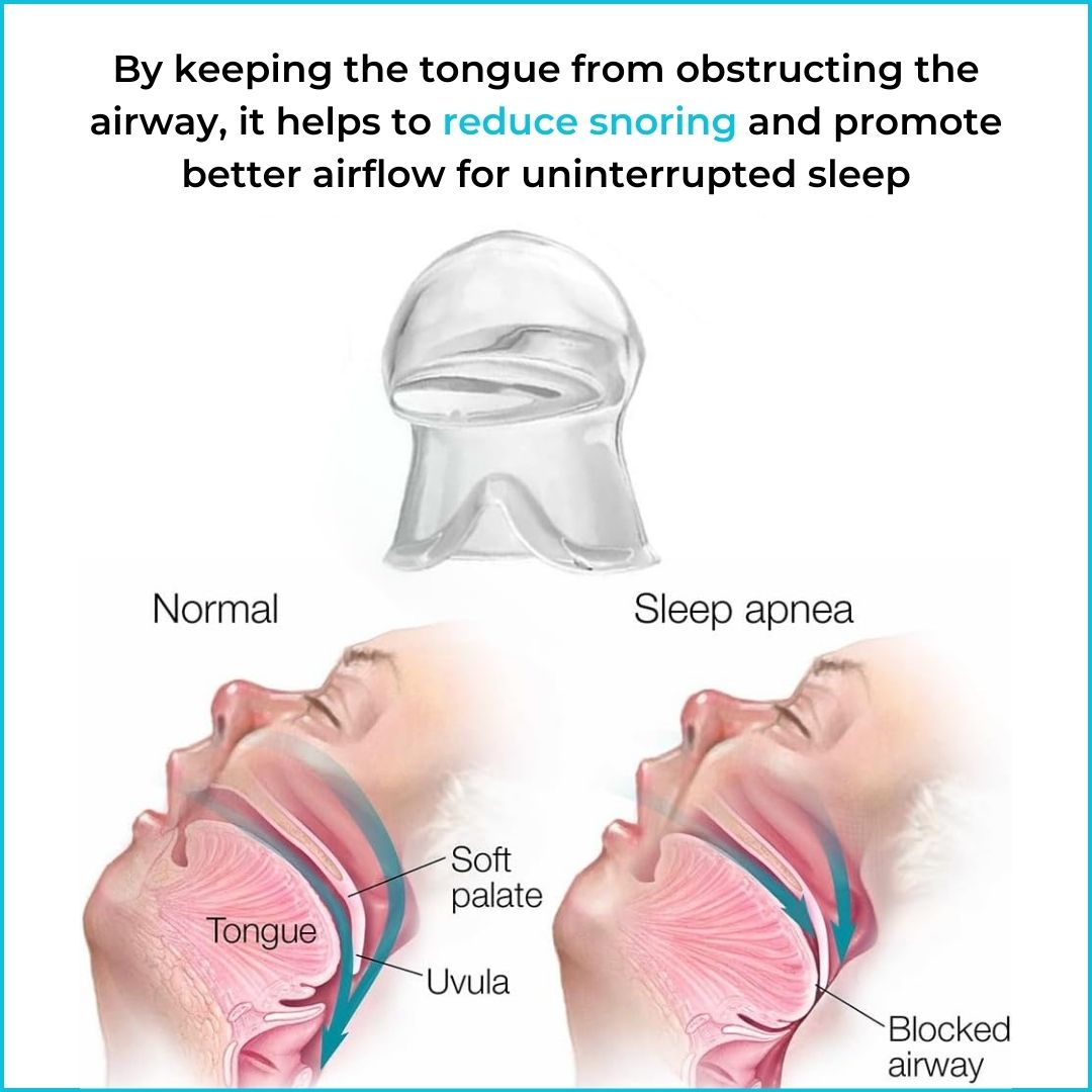 SnoreShield™ - Anti Snoring Device