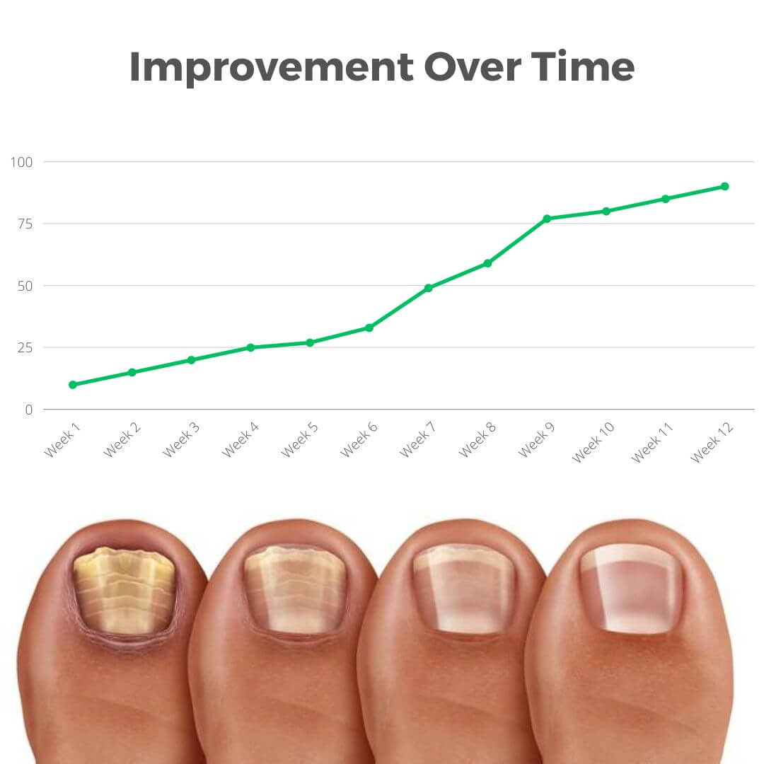 Onyclear™️ - Antifungal Laser Device